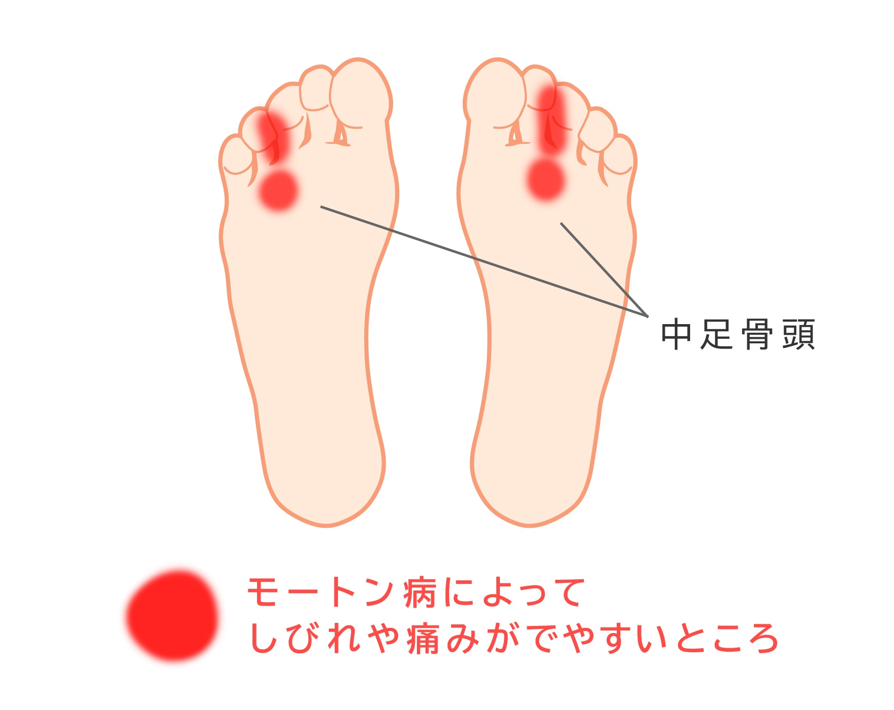 理学療法士監修】足・膝・腰の痛みに効く！インソールの効果を徹底解説